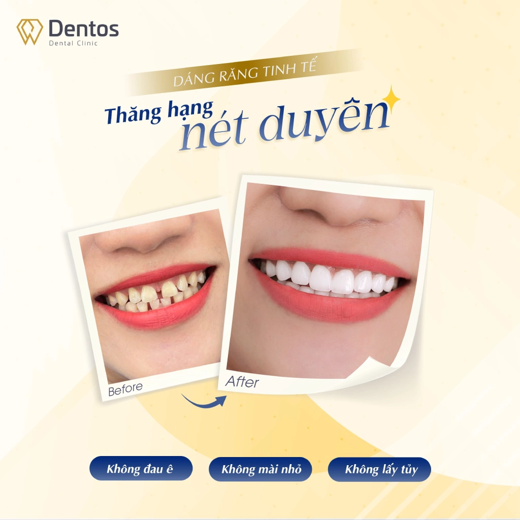 Dán sứ không mài răng được chỉ định ở các ca răng kích thước nhỏ